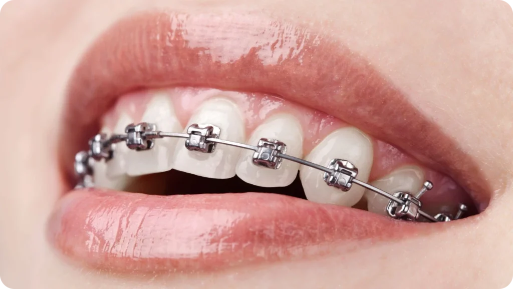 Traitement multi-bagues rhodium céramiques par orthodontiste à Crolles, Dr Comyn