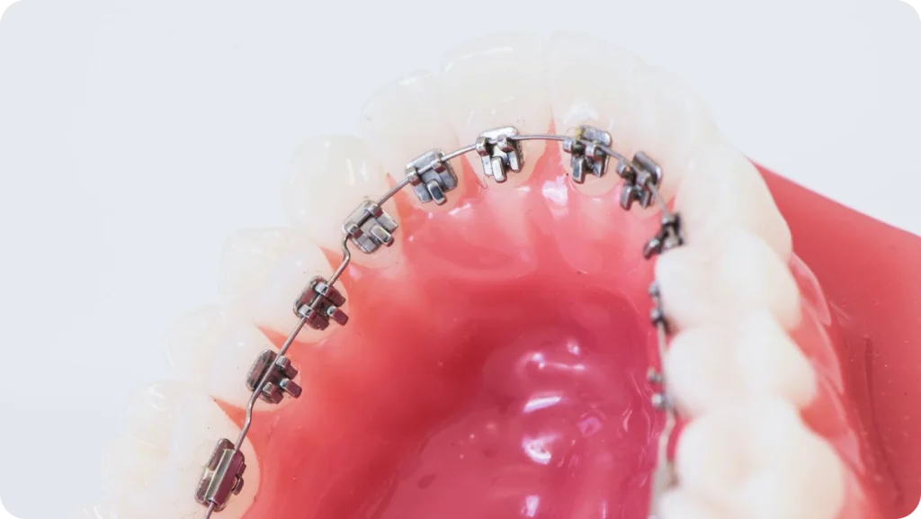 Orthodontie linguale au cabinet du Dr François-Louis Comyn près de Grenoble